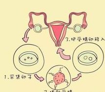 2026在保山市罗氏易位能做三代试管婴儿生子吗，相互易位和罗氏易位有什么区别？